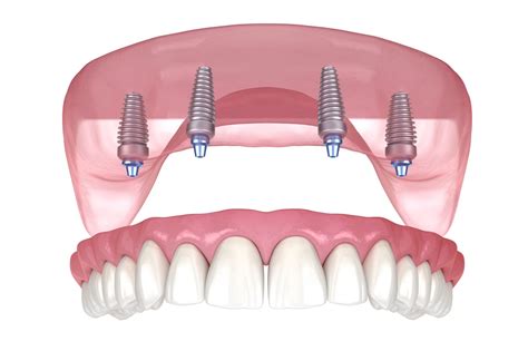 All On 4 Same Day Dental Implants .